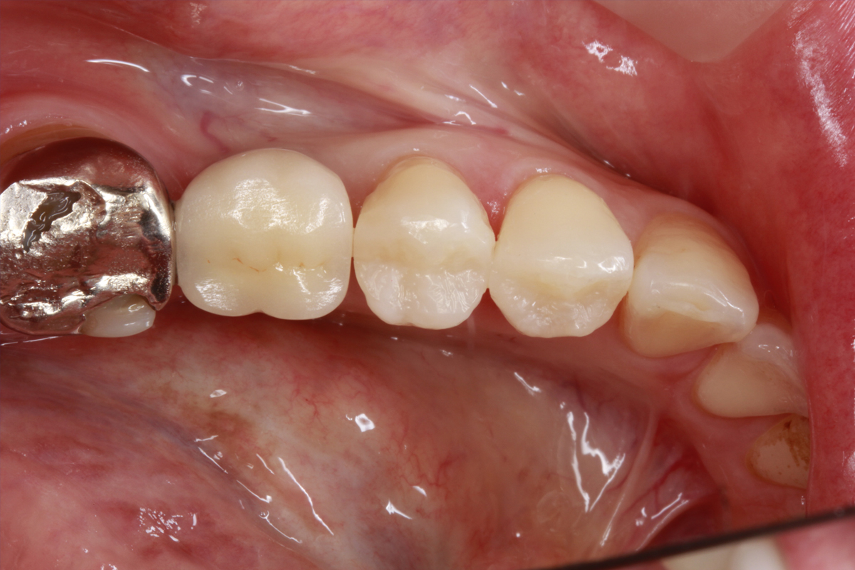 銀歯を安価（安い）に白い歯に（CR）｜埼玉県上尾市の歯医者、かわの歯科医院